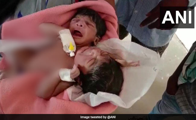 Rare Conjoined Twins Born In Odisha With 2 Heads, 3 Hands