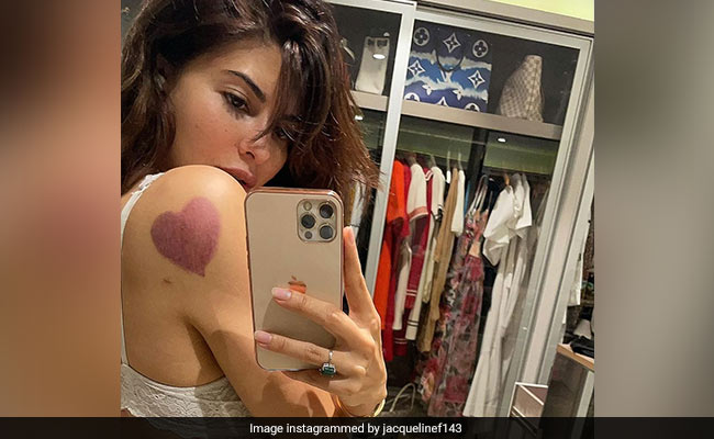 Jacqueline Fernandez's Cupping Therapy Mark Almost Got Us Thinking That She Got A Tattoo