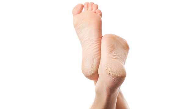Following these hacks consistently can help heal dry heels and keep them soft