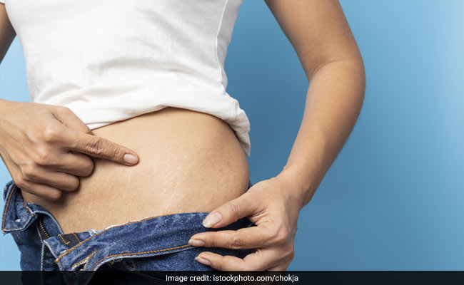 What Causes Stretch Marks And How To Get Rid Of Them