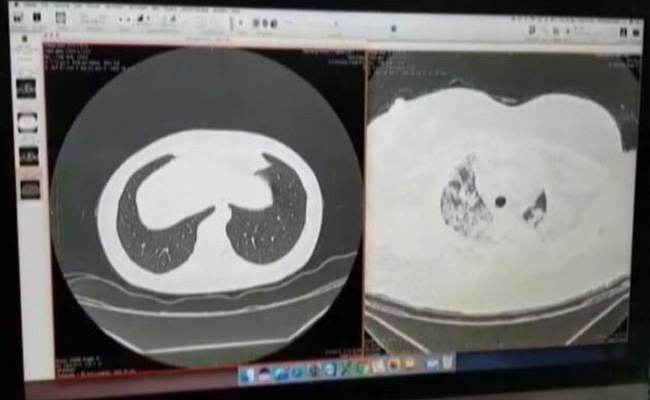 2021 का कोरोना वायरस है 'ज्‍यादा घातक', लंग्‍स को 40% ज्‍यादा डैमेज कर रहा, युवा भी हो रहे प्रभावित