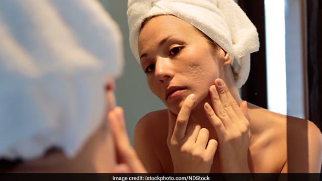 Skincare tips: Consumption of too much sugar is linked with frequent breakouts