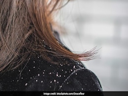 Haircare: Add These Foods To Your Diet To Fight Dandruff In The Winter Haircare: Add These Foods To Your Diet To Fight Dandruff In The Winter