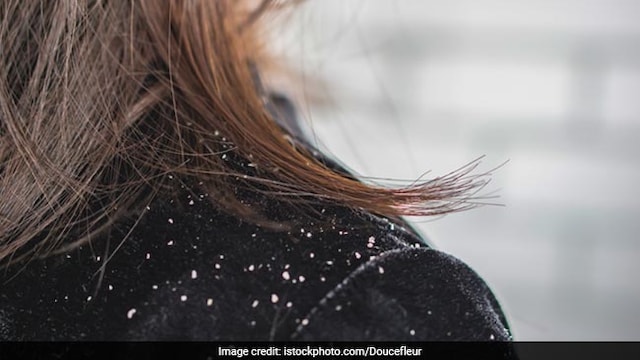 Dandruff is common in winter and can be hard to manage if not treated