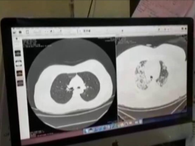 Lung Damage Prevalent In Second Covid Wave: Doctors