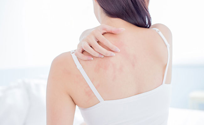 How To Get Rid Of Prickly Heat Overnight: 6 Easy Home Remedies