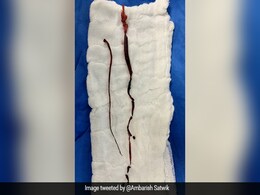 Blood Clotting In Covid Patients: Experts Share Insights Blood Clotting In Covid Patients: Experts Share Insights