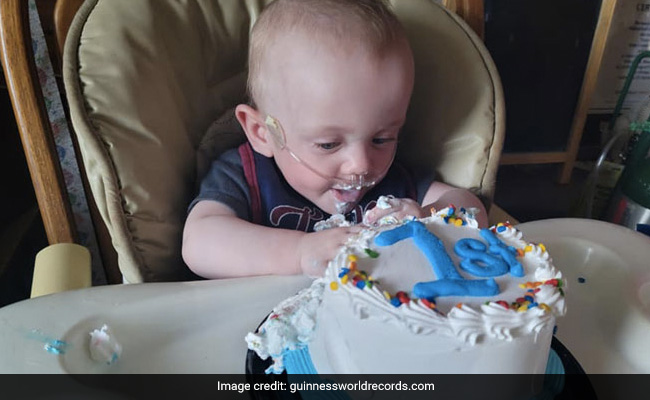 World's Most Premature Baby Celebrates First Birthday. He Was Given 0% Survival Chance