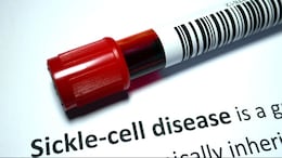 AIIMS Bhopal Study Urges Advanced Screenings For Children With Sickle Cell Disease