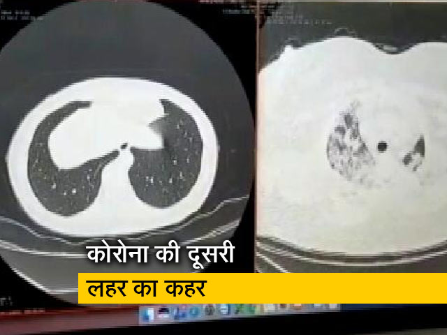 रवीश कुमार का प्राइम टाइम : लंग्स ट्रांसप्लांट की मांग बढ़ी, पर डोनर नहीं