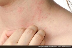 Get Vaccinated Even If You Have Skin Problems Like Eczema: Dr Sachin Dhawan, Fortis Hospital Get Vaccinated Even If You Have Skin Problems Like Eczema: Dr Sachin Dhawan, Fortis Hospital