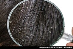 Expert Answers: How To Manage Hair Fall And Dry Scalp After Covid Expert Answers: How To Manage Hair Fall And Dry Scalp After Covid