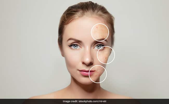 Home Remedies For Hormonal Acne: हार्मोनल एक्ने से निपटने के 4 नेचुरल तरीके और घरेलू नुस्खे