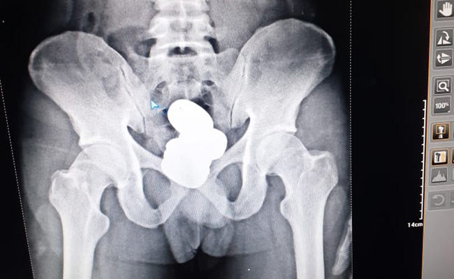 Man Hides Gold Paste Worth Rs 42 Lakh In Rectum, Caught At Imphal Airport