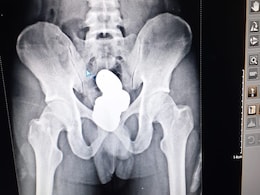 Man Hides Gold Paste Worth Rs 42 Lakh In Rectum, Caught At Imphal Airport Man Hides Gold Paste Worth Rs 42 Lakh In Rectum, Caught At Imphal Airport