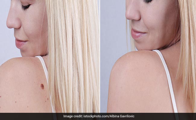 How To Remove Warts: कैमेरे के सामने छुपाने लगते हैं अपने मस्से, तो किचन में रखी इन 7 चीजों को लगाकर पाएं मस्सों से छुटकारा How To Remove Warts: कैमेरे के सामने छुपाने लगते हैं अपने मस्से, तो किचन में रखी इन 7 चीजों को लगाकर पाएं मस्सों से छुटकारा