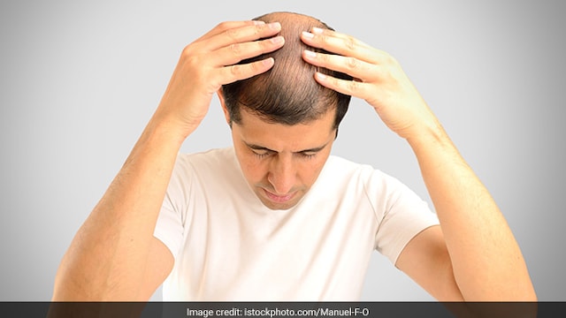 Hair fall: Hair fall affects both men and women these days