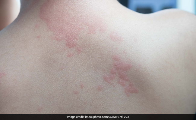 Remove Burn Marks : पुराने से पुराने जले के निशानों को कहें बाय-बाय, अपनाएं ये घरेलू उपाय