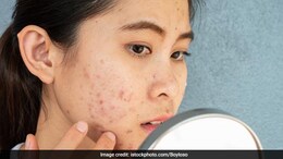 Diet Tips: 7 Tips That May Help To Reduce Acne