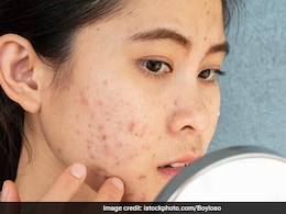 रात को सोने से पहले गर्म पानी में मिला दें ये पीले बीज, सुबह खाली पेट पिएं, जिंदगी में कभी नहीं होंगे पिंपल्स और मुंहासे रात को सोने से पहले गर्म पानी में मिला दें ये पीले बीज, सुबह खाली पेट पिएं, जिंदगी में कभी नहीं होंगे पिंपल्स और मुंहासे