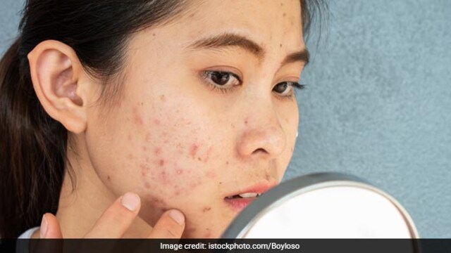 Recurring stubborn acne may be a sign of PCOS