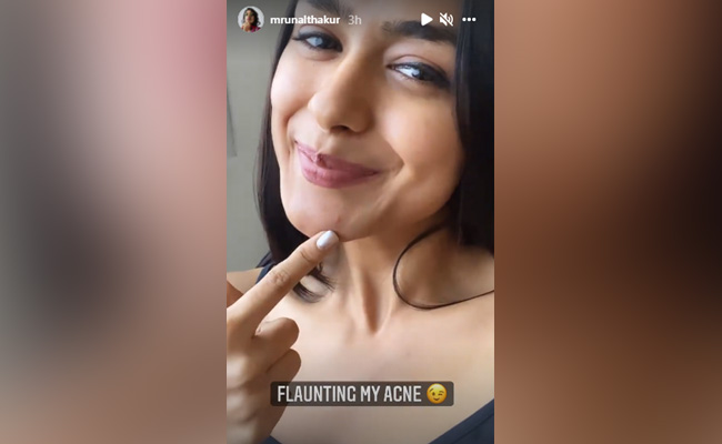 Mrunal Thakur Shows Us How To Tackle Those Pesky Pimples With Grace