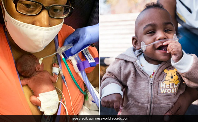 The Boy Who Made History As World's Most Premature Baby To Survive