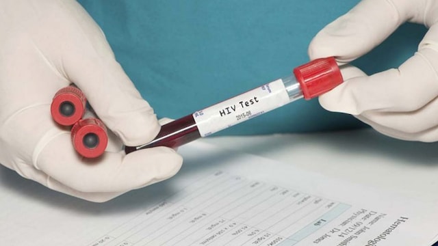 HIV is the virus that causes AIDS