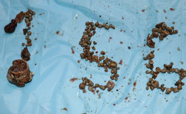 Record 156 Kidney Stones Removed From Single Patient In Hyderabad