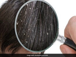 Dandruff And Hair Fall: सर्दियों में इन गलतियों से बढ़ सकता है डैंड्रफ, आजमाएं ये आयुर्वेदिक टिप्स Dandruff And Hair Fall: सर्दियों में इन गलतियों से बढ़ सकता है डैंड्रफ, आजमाएं ये आयुर्वेदिक टिप्स