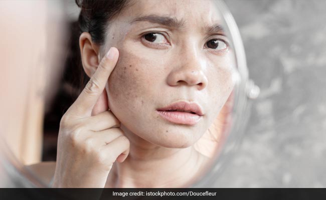 10 Best Face Cream For Pimple And Black Spots