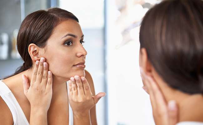Melasma is seen as dark brown patches on the cheeks and nose