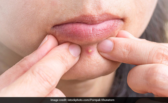 Skin Care: चेहरे पर पिंपल्स ने कर दिया है नाक में दम तो इस्तेमाल करें ये 4 फेस पैक, कुछ ही घंटों में दिखने लगेगा असर