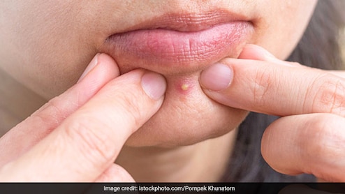 पिंपल्स चेहरे पर छोड़ गए हैं जिद्दी निशान? मुंह में पानी भरकर करिए ये 1 काम, हल्के होने लगेंगे दाग