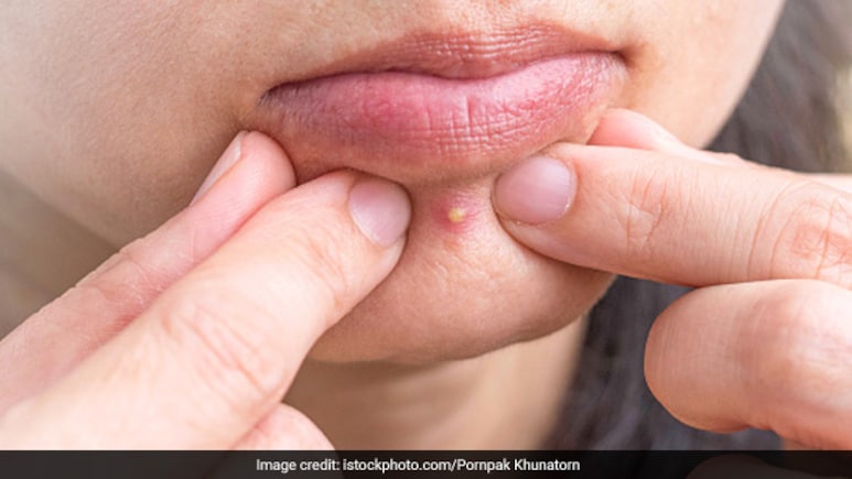 पिंपल्स चेहरे पर छोड़ गए हैं जिद्दी निशान? मुंह में पानी भरकर करिए ये 1 काम, हल्के होने लगेंगे दाग