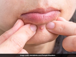 पिंपल्स चेहरे पर छोड़ गए हैं जिद्दी निशान? मुंह में पानी भरकर करिए ये 1 काम, हल्के होने लगेंगे दाग पिंपल्स चेहरे पर छोड़ गए हैं जिद्दी निशान? मुंह में पानी भरकर करिए ये 1 काम, हल्के होने लगेंगे दाग