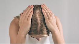 Biotin Deficiency: Expert Reveals The Cause Of Hair Thinning And Foods To Overcome It