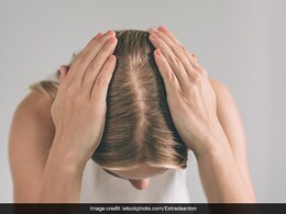 Biotin Deficiency: Expert Reveals The Cause Of Hair Thinning And Foods To Overcome It Biotin Deficiency: Expert Reveals The Cause Of Hair Thinning And Foods To Overcome It