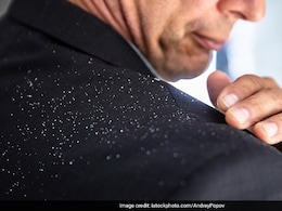 सिर से जहां-तहां झड़कर गिरने लगता है डैंड्रफ तो इस तरह तुरंत पा लीजिए छुटकारा, सिर खुजाते नहीं रहना पड़ेगा  सिर से जहां-तहां झड़कर गिरने लगता है डैंड्रफ तो इस तरह तुरंत पा लीजिए छुटकारा, सिर खुजाते नहीं रहना पड़ेगा