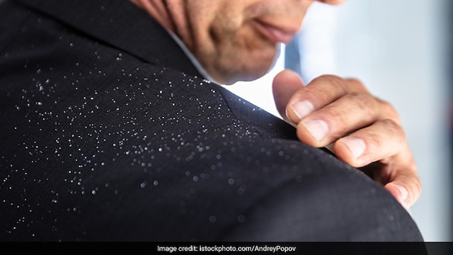 Dandruff may be a result of dry scalp in winter
