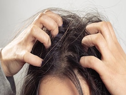 Scalp Pimple यानि सिर में होने वाले दानों से परेशान हैं तो आज ही अपनाएं ये घरेलू उपाय, झट मिलेगी राहत  Scalp Pimple यानि सिर में होने वाले दानों से परेशान हैं तो आज ही अपनाएं ये घरेलू उपाय, झट मिलेगी राहत