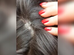 Dandruff Home Remedies: सर्दियों में आप भी डैंड्रफ से हो गए हैं परेशान तो ये घरेलू उपाय आपके आएंगे काम, आज ही अपनाइए Dandruff Home Remedies: सर्दियों में आप भी डैंड्रफ से हो गए हैं परेशान तो ये घरेलू उपाय आपके आएंगे काम, आज ही अपनाइए
