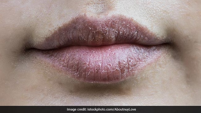 Smoking and sun exposure can lead dark lips