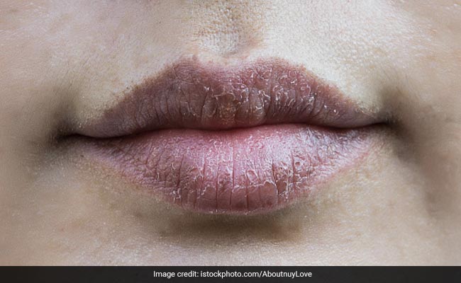 Smoking and sun exposure can lead dark lips