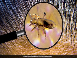 Hair Lice Remedies: बच्चों के सिर से जुएं निकालने के अचूक उपाय, जानें बालों में जूं कैसे खत्म करें? Hair Lice Remedies: बच्चों के सिर से जुएं निकालने के अचूक उपाय, जानें बालों में जूं कैसे खत्म करें?