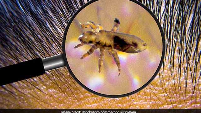 In more severe cases, a healthcare professional may prescribe stronger lice treatments