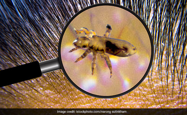 In more severe cases, a healthcare professional may prescribe stronger lice treatments