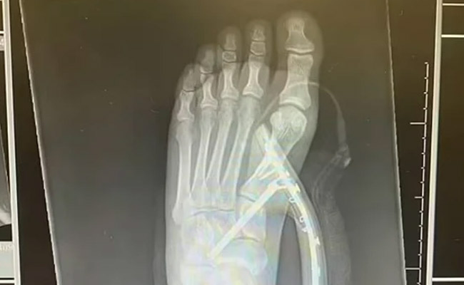 मकड़ी को देख बुरी तरह डरी महिला, फिर अस्पताल में कराना पड़ा इलाज