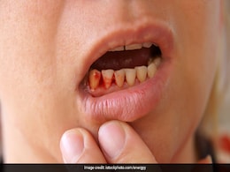 क्या आपके मसूड़ों से हो रही है Bleeding तो अपनाएं ये घरेलू नुस्खा, खून आना हो जाएगा बंद क्या आपके मसूड़ों से हो रही है Bleeding तो अपनाएं ये घरेलू नुस्खा, खून आना हो जाएगा बंद