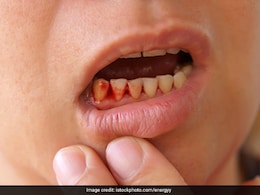 मसूड़ों से खून आना किस बीमारी का संकेत है? इन अंदरूनी समस्याओं की ओर करता है इशारा, जानें आयुर्वेदिक उपाय मसूड़ों से खून आना किस बीमारी का संकेत है? इन अंदरूनी समस्याओं की ओर करता है इशारा, जानें आयुर्वेदिक उपाय